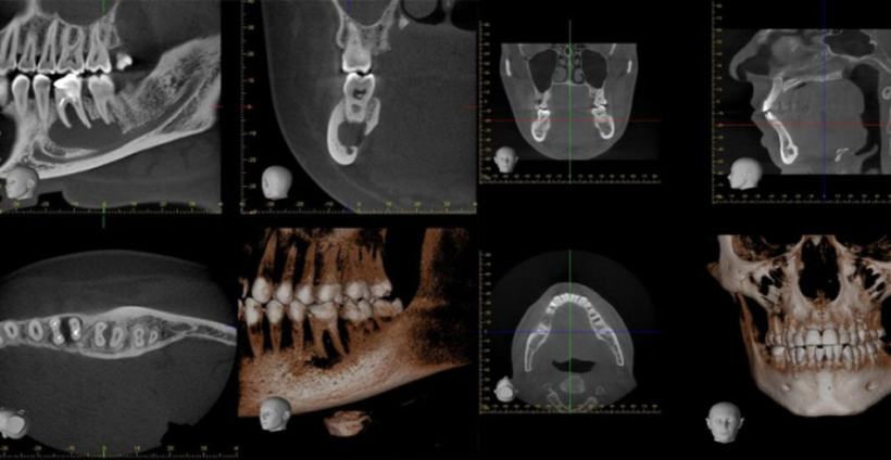 Dental Tomografi